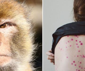 Dos jóvenes son aisladas por ser sospechosas de portar viruela del mono