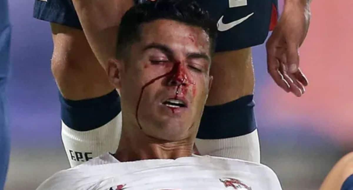 Cristiano Ronaldo sufre duro golpe en el rostro