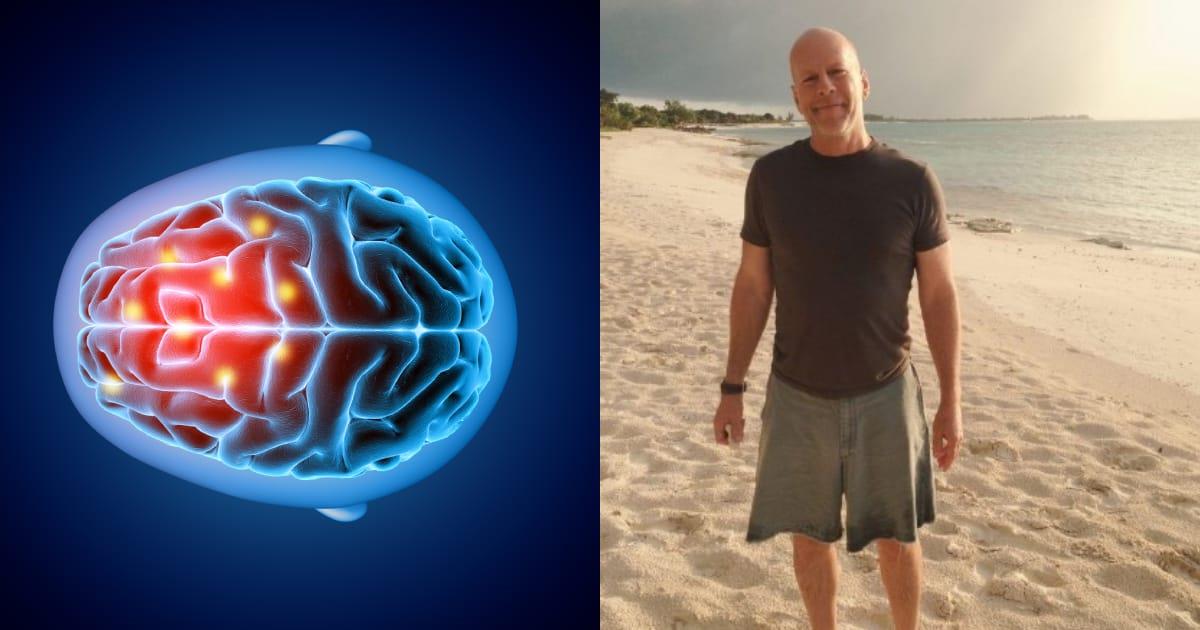 Demencia frontotemporal, la enfermedad sin cura que padece Bruce Willis