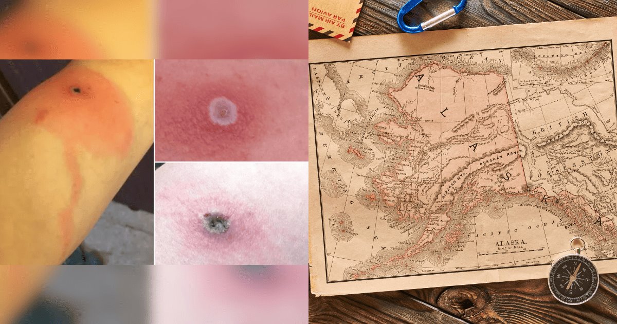 Viruela de Alaska: la enfermedad que ha cobrado su primera víctima humana