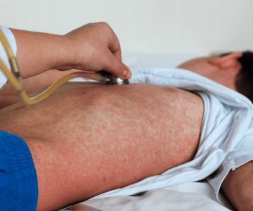 Aumenta el riesgo de sarampión por casos importados en México