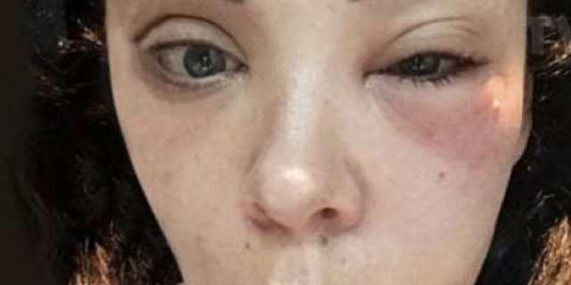 Por tratamiento facial se infecta Marichelo