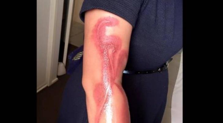 Mujer sufre quemadura en el brazo por iPhone 7