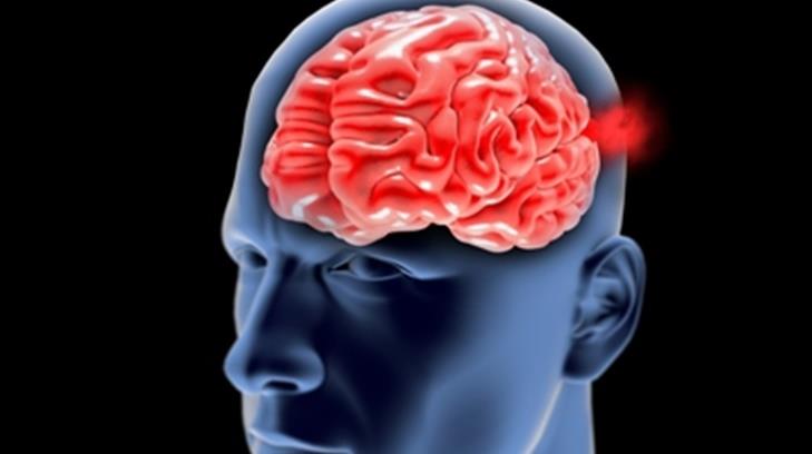 #CUIDADO | Dolor intenso en la cabeza podría ser síntoma de un aneurisma cerebral