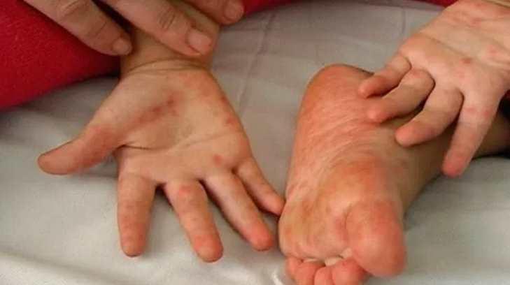 Aumentan casos de la ‘enfermedad de manos, pies y boca’ en Sonora