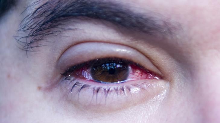 Recomiendan tratar conjuntivitis infecciosa como medida preventiva de coronavirus