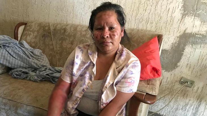 Isela sufrió quemaduras mientras trabajaba y ahora no tiene sustento; solicita apoyo para sanar