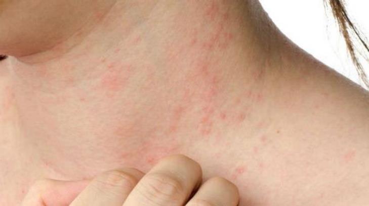 Clima desértico, un factor importante para dermatitis atópica